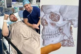 Jai Opetaia inflicts 'worst broken jaw ever seen' on opponent Claudio Squeo