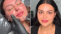 Love Island star Emma’s pre-villa glow up as she gets lip, chin & cheek fillers