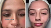 I cured my fungal acne & got glass skin with a £2 buy you can find anywhere