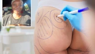 I’m a masseuse - the disgusting truth about BBLs that no one tells you