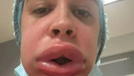My lips ballooned like a blobfish after having filler REMOVED, I was crying