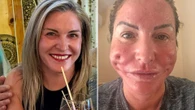 15-min facelift left me with gaping holes - surgeon had only been trained for a WEEK