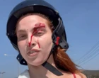 Love Island star left with bloody wounds after motorbike crash in Thailand