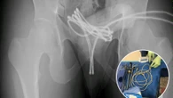 Man shoved USB cable up his penis in 'risky sex act' - as doctors issue warning