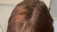 I always had thin hair until using Ordinary’s serum & had new growth in a month