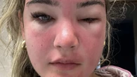 I was left looking like a wasp-stung dog after just ONE hour of on the beach