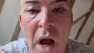 Reality star, 56, shows off bruised & swollen face after getting eyelid surgery