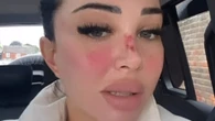 Tulisa shows off bloodied nose as she reveals SIX painful beauty procedures