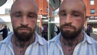 MAFS star sparks concern with extremely swollen head in pics after surgery
