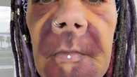 £8k Turkey op left me looking like I'd been in crash… & I'm STILL toothless