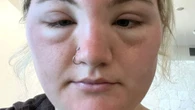 I looked like ET after hol sun poisoning - I wore sun cream but it's not enough