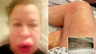 Mum’s face blew up and blisters engulfed body after she saw black mould in home