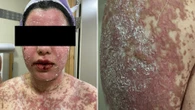 Woman watched skin ‘peel & detach' from body days after taking routine NHS drug