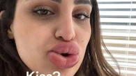 I got my lip filler dissolved -people say I look like Monsters Inc character