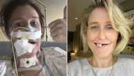 I have hairs in my mouth after my leg was used to build face after cancer