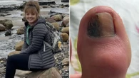 I covered an ugly mark on my toenail with varnish - I had no clue it was cancer