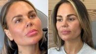 Geordie Shore star looks very different after getting face filler dissolved