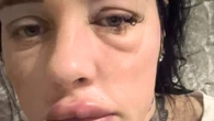 I spent 3 months hiding away after my pus-filled lips leaked all down my face