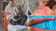 Nurse mum warns owners of trendy fire pits that ‘melted skin off her body'