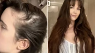 I had bald patches at 21 & tried all the hacks - a viral Amazon buy reversed it