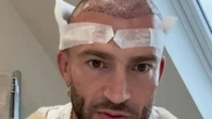 Jake Quickenden has THIRD hair transplant & says pain was 'close to childbirth'