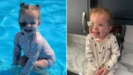 I’m lasering my daughter’s birthmark off - I’m sick of nasty comments