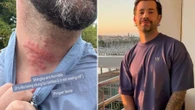 Towie star reveals he’s been struck down with agonising health condition