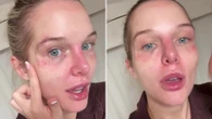 Helen Flanagan shows off her bruised, bloodied face after cosmetic tweakment