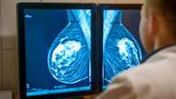 'Landmark' moment as NHS clinics use AI to 'detect breast cancer cases earlier'