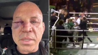 MMA icon shows off horror injuries after being knocked out in 11-man brawl