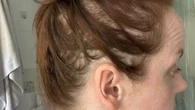 I've had major fat jab hair loss so tried 3 hacks to cover my bald patches