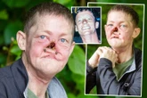 I’ve been left with no nose - I complained to docs for months of breathing pain