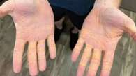 Shock images show man's yellow hands after diet of meat, butter and cheese 