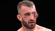 Fans fear UFC star could lose eye after horror swelling sees fight called off