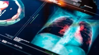 'Silent' disease that causes sudden heart failure & one in FIVE Brits have it