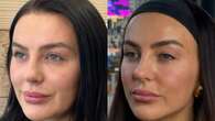 Love Island star Rosie Williams reveals brand new look after dissolving filler