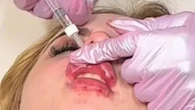 ‘Butchered’ beauty fans cry as woman’s Bratz Doll lip filler leaves pout sore