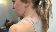 I'll never stay in Butlins again after being left covered in pus-filled spots