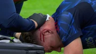 Gyokeres left with gruesome gash in head after collision with Arsenal pal