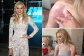 Abbie Quinnen shows true extent of burns 6 months after freak accident with AJ