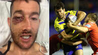 Rugby star facing 'numb face for life' after 11 fractures - but is ready to play