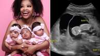 I fell pregnant with twins when ALREADY expecting & found out during 'miscarriage'