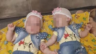Родившиеся с минимальным весом близнецы из Павлодара нуждаются в лечении от гидроцефалии