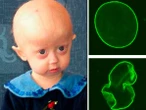 Progeria powoduje szybkie starzenie się u dzieci. Poznaj przyczyny, objawy i leczenie HGPS