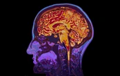 Naukowcy odkryli powiązanie między cholesterolem w mózgu a chorobą Alzheimera