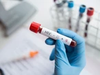 Przełom w leczeniu AIDS. Szansa na lek w jednym zastrzyku