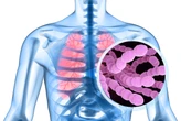 Pneumokoki: niebezpieczne bakterie oporne na antybiotyki. Istnieje na nie jedna skuteczna metoda