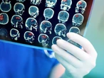 Dzieci z tą diagnozą nie przeżywają roku. Trwają badania nad nowymi terapiami
