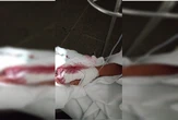 Jovem que teve corte profundo na mão aguarda atendimento há 6 dias