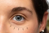 Confira seis passos para suavizar as bolsas nos olhos naturalmente